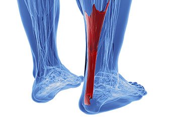 Achilles Tendonitis Treatment in the Farmington, MI 48335 area