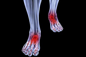Arthritic foot and ankle care treatment in the Farmington, MI 48335 area