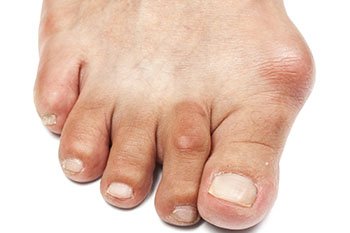 Bunions treatment in Farmington, MI 48335