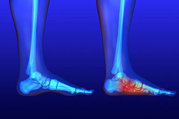 Flat Feet Treatment in the Farmington, MI 48335 area