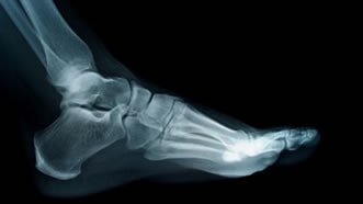 Foot and Ankle Fractures Treatment in the Farmington, MI 48335 area