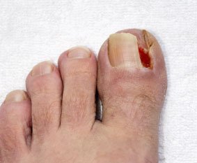ingrown toenail in the Farmington, MI 48335 area