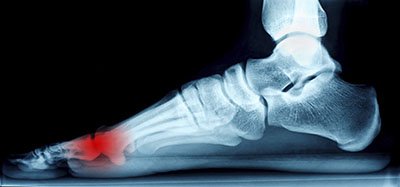 mortons neuroma treatment in the Farmington, MI 48335 area