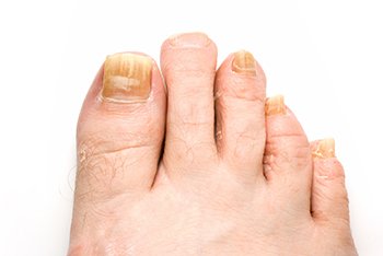 toenail fungus treatment in the Farmington, MI 48335 area