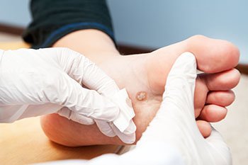 Plantar Warts Treatment in the Farmington, MI 48335 area