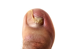 Treatments for Nail Fungus