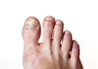 Symptoms of Toenail Fungus