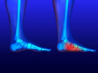 What Are Flat Feet?