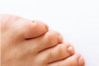 Types of Foot Corns