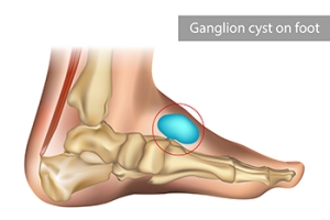 Understanding Ganglion Cysts on the Feet