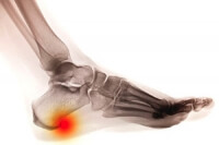 Diagnosing Heel Spurs