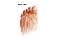 Symptoms of Morton’s Neuroma