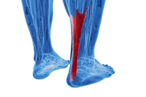 Achilles Tendon Ruptures in Sports Activities
