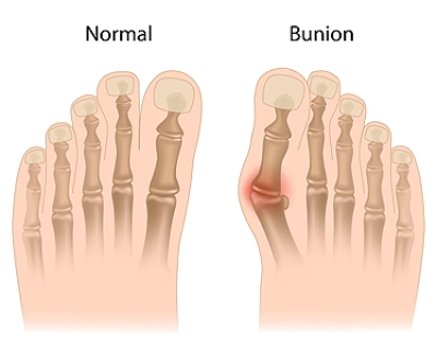 Bunions and Podiatric Care