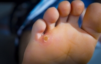 Differences Between Corns and Calluses on the Feet