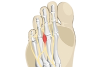 Morton’s Neuroma and the Invisible Pebble