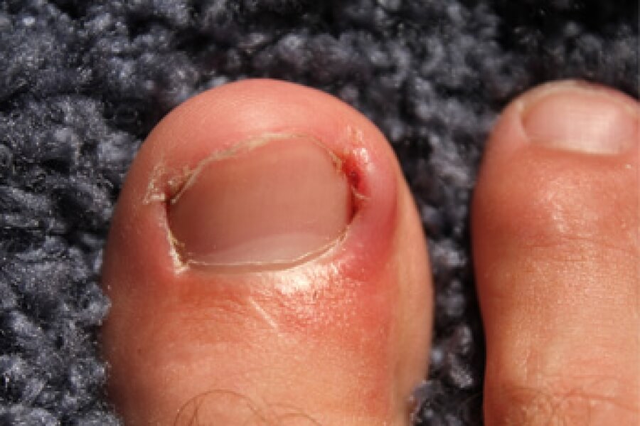 Best way to discount heal ingrown toenail
