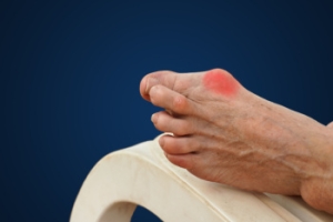 Bunions and the Importance of Podiatric Care