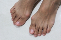 Surgical Remedies for Bunions