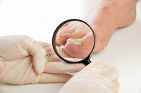 Possible Causes of Toenail Fungus