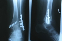 Do I Have a Stress Fracture?