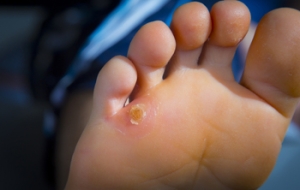 Common Risk Factors Linked to Corns