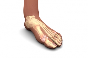 Exploring the Genetic Link to Gout