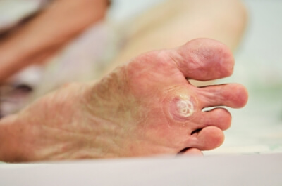 Dealing With Uncomfortable Plantar Warts