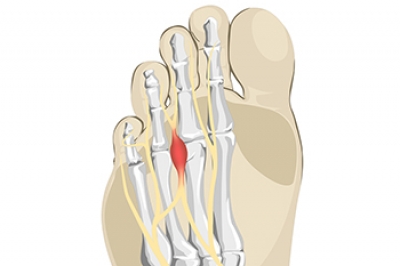 What Is Morton&#039;s Neuroma?