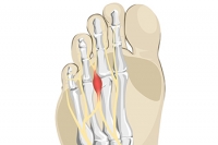 What Is Morton's Neuroma?