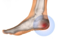 Causes of Heel Pain