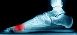 Two Tiny Bones Can Cause a Giant Pain