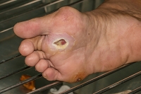 Avoiding Serious Diabetic Foot Complications