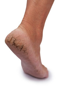 What Causes Cracked Heels?