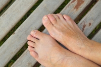 An Overview of Hammertoe