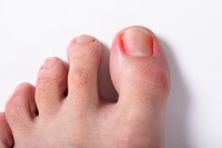 Can Ingrown Toenails Become Infected?