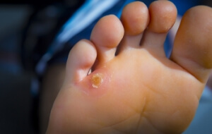 How Are Corns Removed?