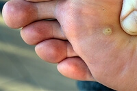 Decoding the Telltale Symptoms of Plantar Warts