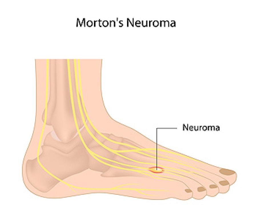 Exercises May Help Morton's Neuroma