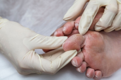 Foot Complications Linked to Diabetes