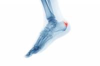 Causes, Symptoms, and Relief Options for Heel Spurs