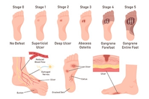 Managing Foot Ulcers With Expert Care